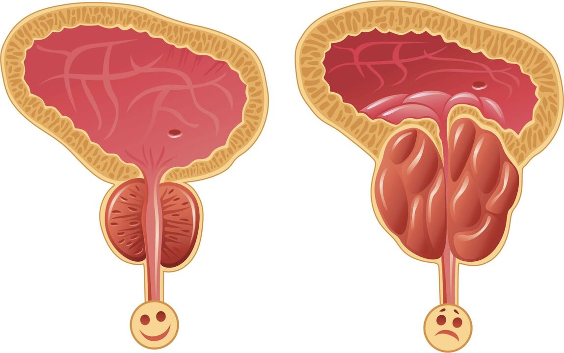 reasons for the development of prostatitis