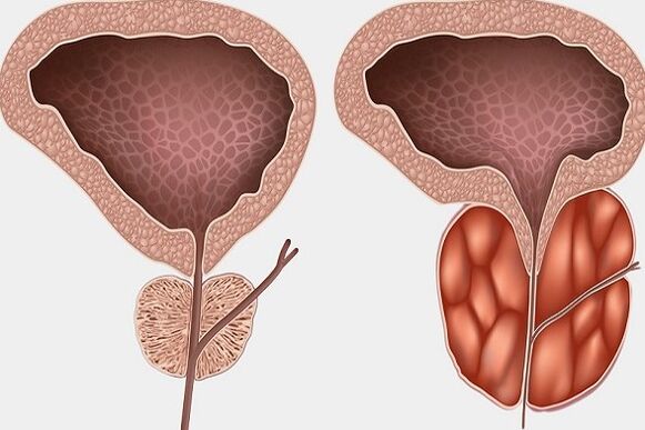 Inflammation of the prostate