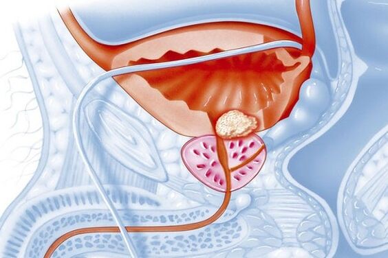 Inflammatory process in the prostate