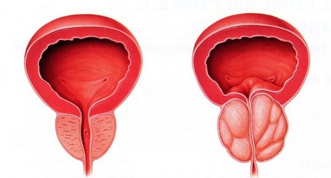 healthy and inflamed prostate with chronic prostatitis