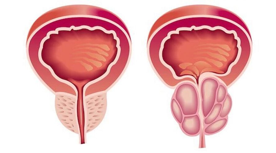Healthy and inflamed prostate with prostatitis