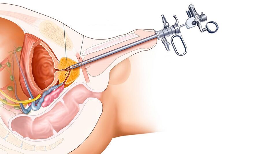 Surgical treatment of prostatitis
