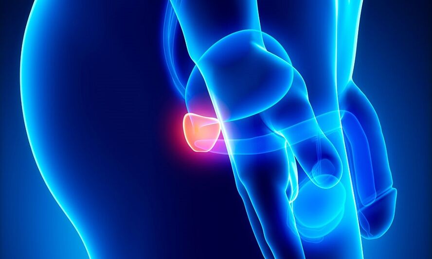 inflammation of the prostate with prostatitis
